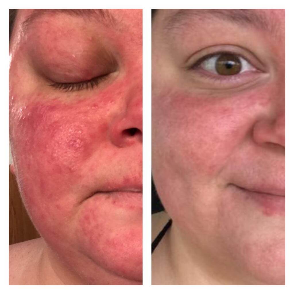 Before and after redness on a cheek