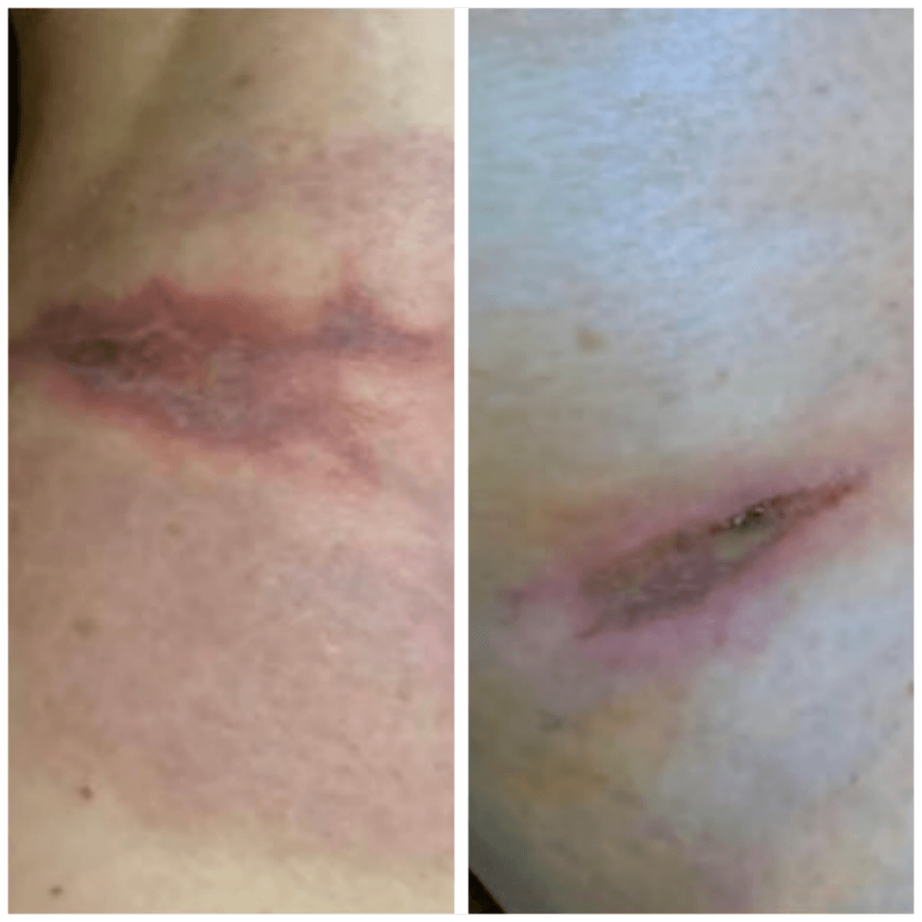 Before and after a healing burn on skin